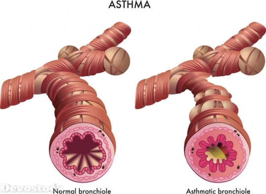 Devostock Asthma  (30)