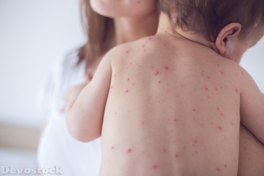 Devostock Skin Allergy  (16)