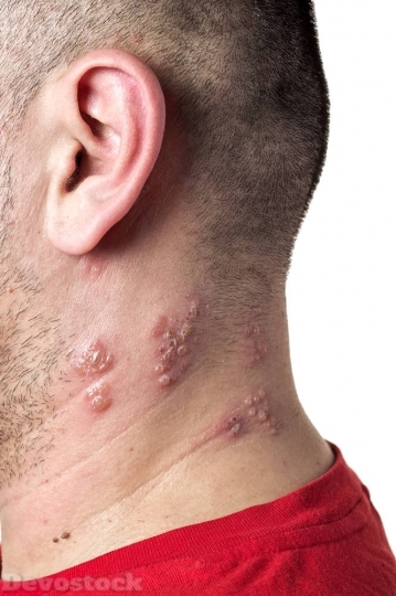 Devostock Skin Allergy  (19)