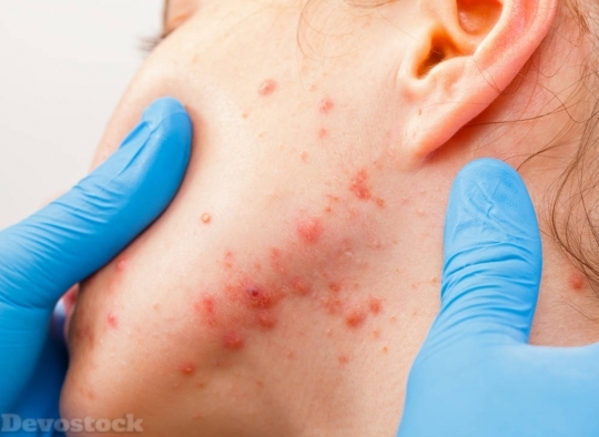 Devostock Skin Allergy  (21)